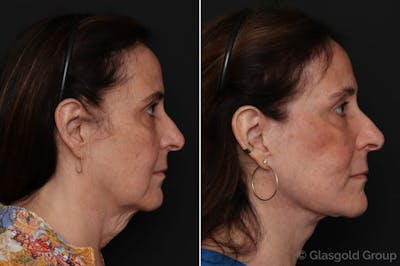 Facelift Before & After Gallery - Patient 172867 - Image 1