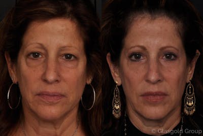 Upper Eyelid Before & After Gallery - Patient 300025 - Image 1