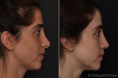 Revision Rhinoplasty Before & After Gallery - Patient 175595 - Image 1