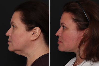 Facelift Before & After Gallery - Patient 389694 - Image 1