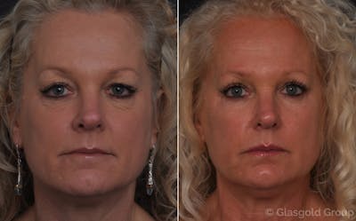 Upper Eyelid Before & After Gallery - Patient 863962 - Image 1