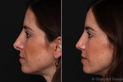 Revision Rhinoplasty Before & After Gallery - Patient 286881 - Image 1