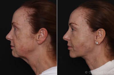 Facelift Before & After Gallery - Patient 167794 - Image 1