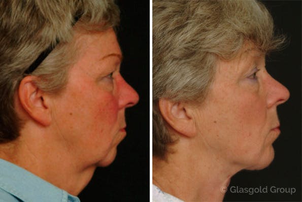 Neck Lift Before & After Gallery - Patient 394034 - Image 1