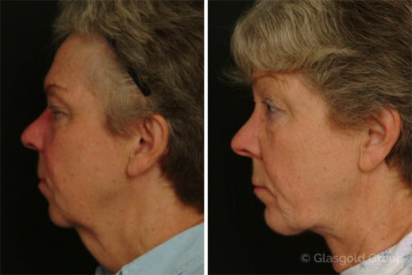 Neck Lift Before & After Gallery - Patient 394034 - Image 2