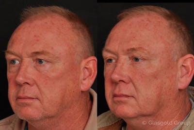 Lower Eyelid Before & After Gallery - Patient 209667 - Image 1