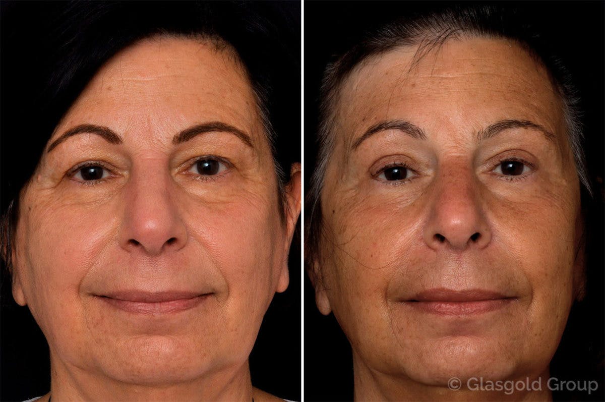 Upper Eyelid Before & After Gallery - Patient 181846 - Image 2