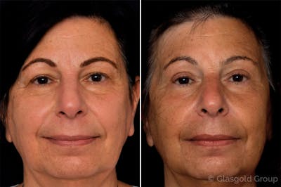 Upper Eyelid Before & After Gallery - Patient 181846 - Image 1