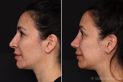 Revision Rhinoplasty Before & After Gallery - Patient 431190 - Image 1