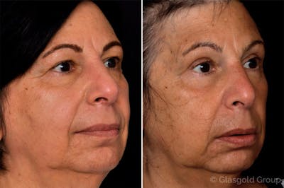 Upper Eyelid Before & After Gallery - Patient 181846 - Image 1