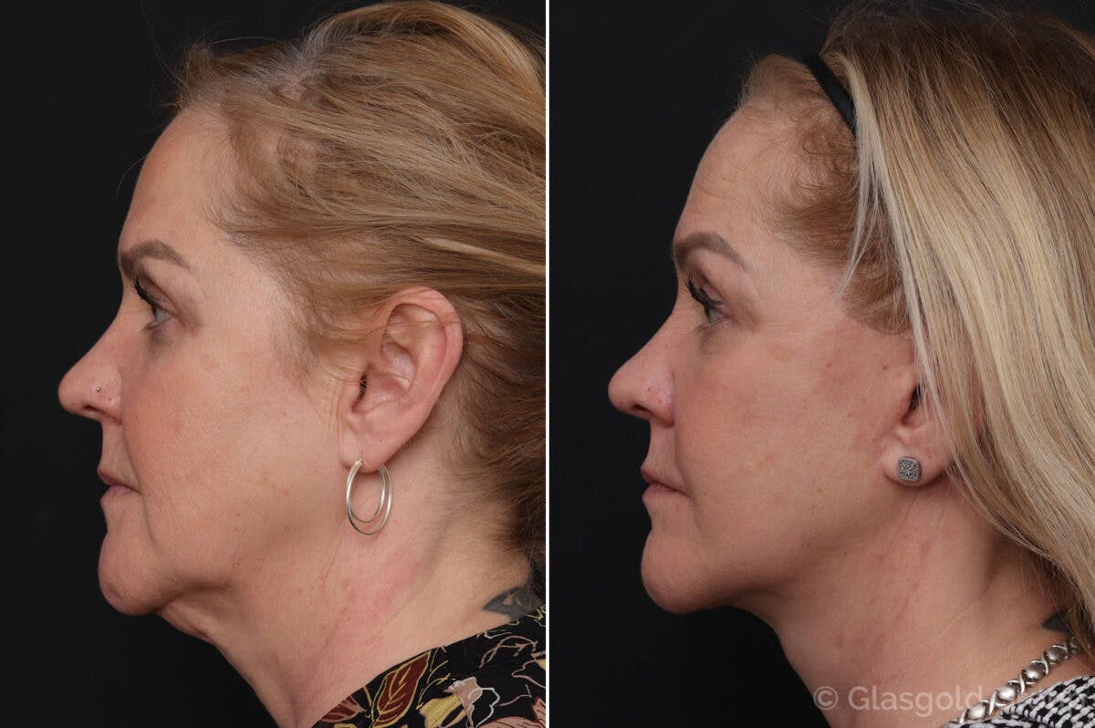 Facelift Before & After Gallery - Patient 418090 - Image 2