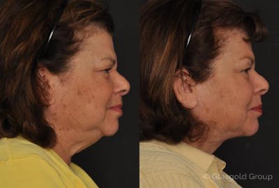 Neck Lift Before & After Gallery - Patient 257585 - Image 1