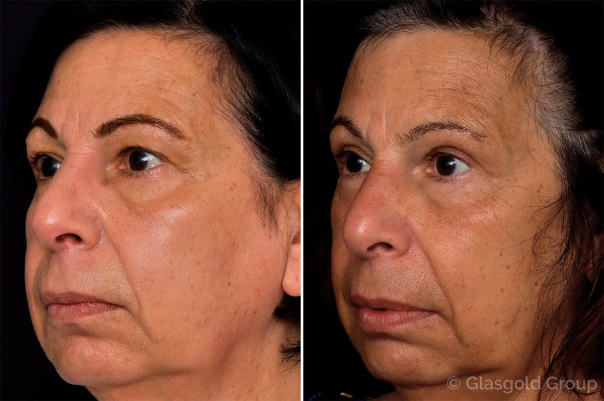 Upper Eyelid Before & After Gallery - Patient 181846 - Image 3