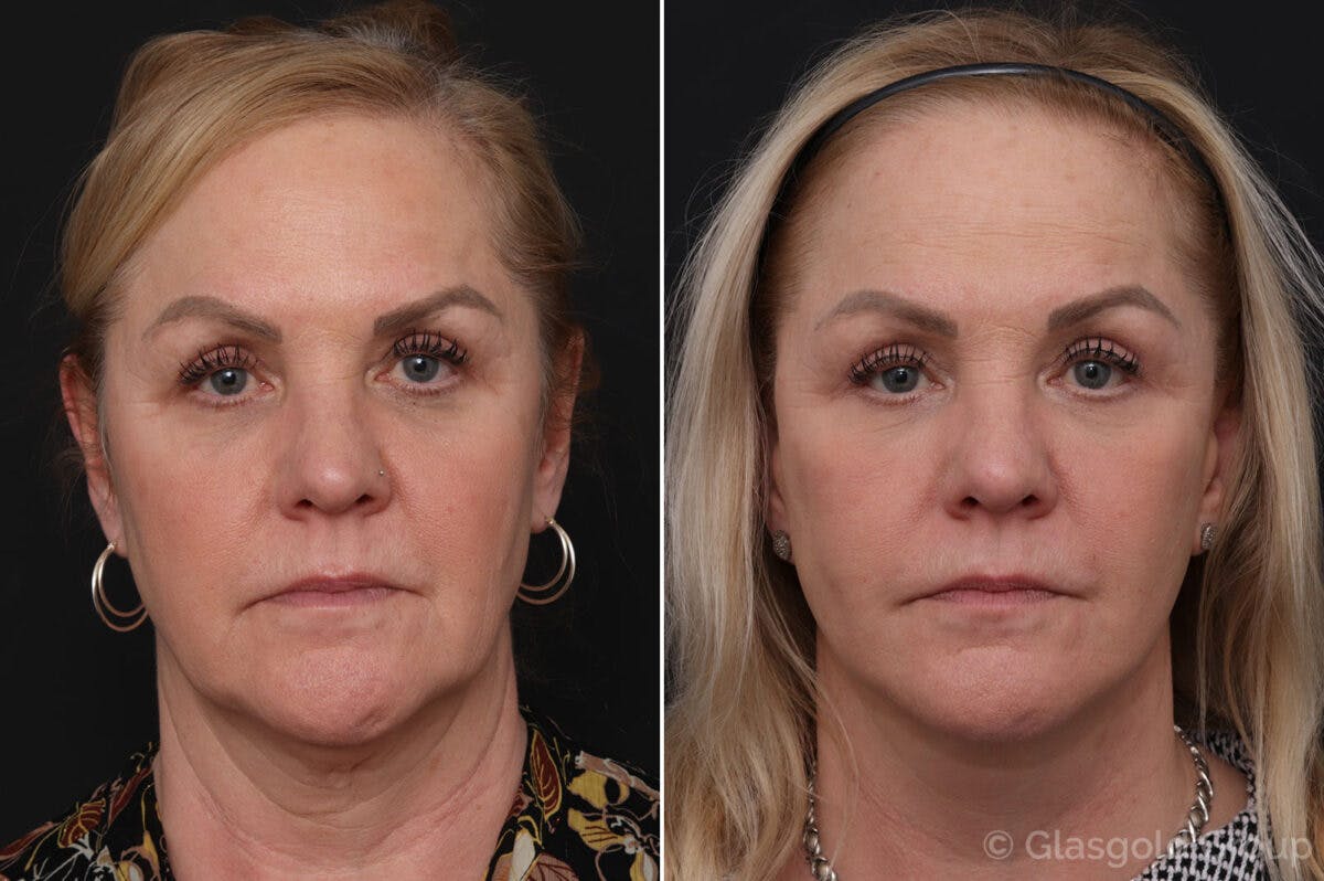 Facelift Before & After Gallery - Patient 418090 - Image 3