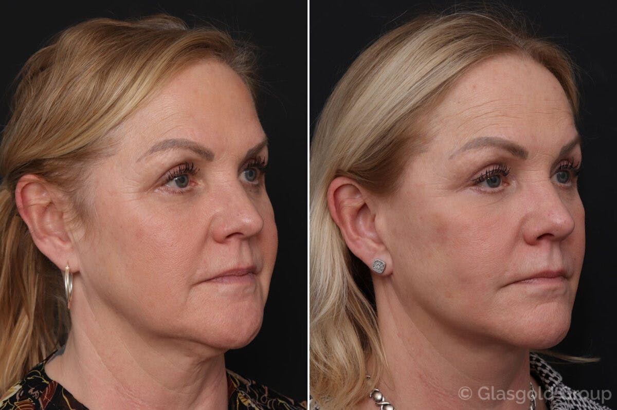 Facelift Before & After Gallery - Patient 418090 - Image 1