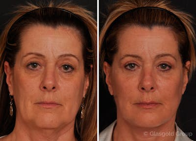 Upper Eyelid Before & After Gallery - Patient 471914 - Image 1