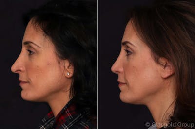 Revision Rhinoplasty Before & After Gallery - Patient 222970 - Image 1