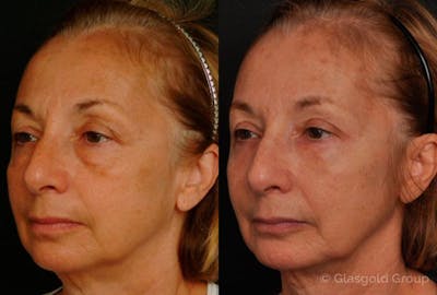 Lower Eyelid Before & After Gallery - Patient 982064 - Image 1