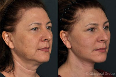 Facelift Before & After Gallery - Patient 152268 - Image 1