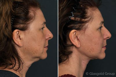 Facelift Before & After Gallery - Patient 152268 - Image 1