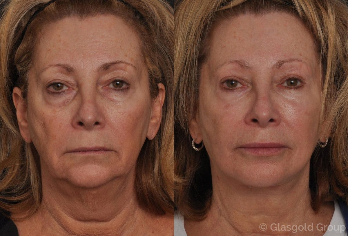 Upper Eyelid Before & After Gallery - Patient 112878 - Image 3