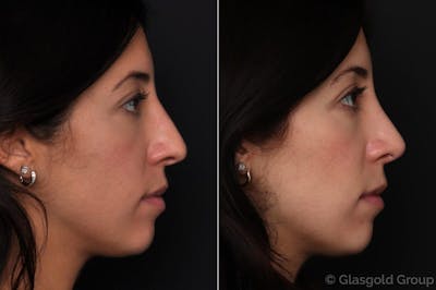 Revision Rhinoplasty Before & After Gallery - Patient 216241 - Image 1