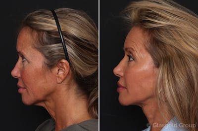 Facelift Before & After Gallery - Patient 428688 - Image 1