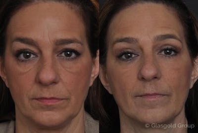 Upper Eyelid Before & After Gallery - Patient 695899 - Image 1