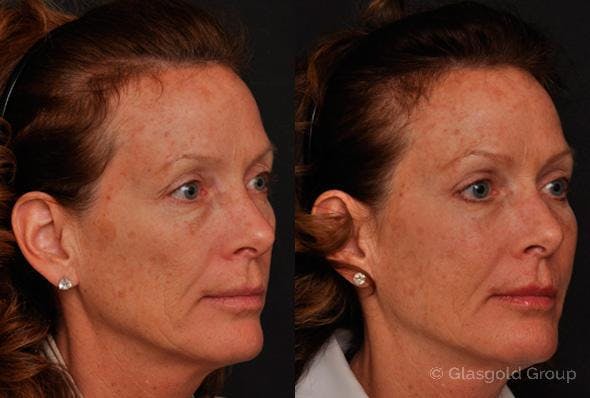 Lower Eyelid Before & After Gallery - Patient 242849 - Image 2