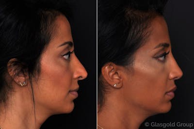 Revision Rhinoplasty Before & After Gallery - Patient 146652 - Image 1