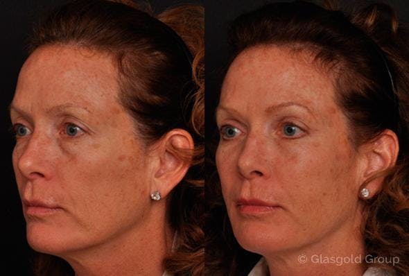Lower Eyelid Before & After Gallery - Patient 242849 - Image 1