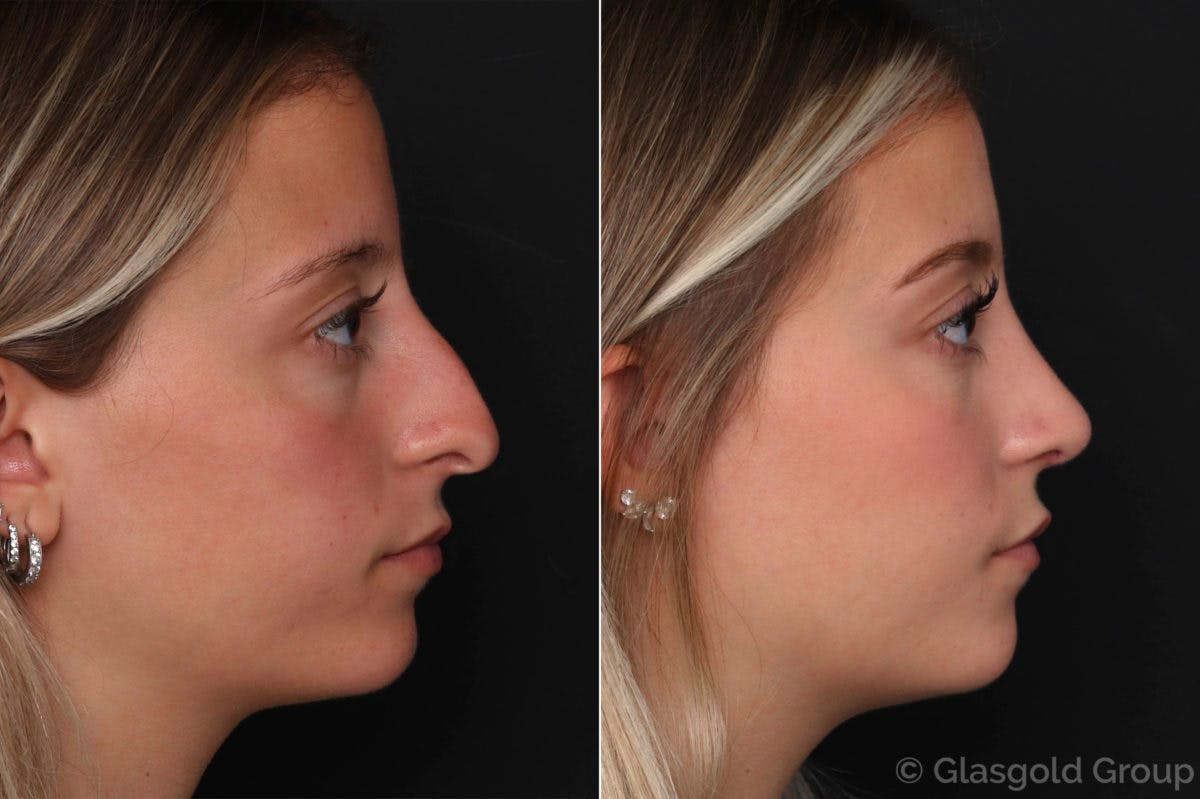 Rhinoplasty Before & After Gallery - Patient 331438 - Image 1
