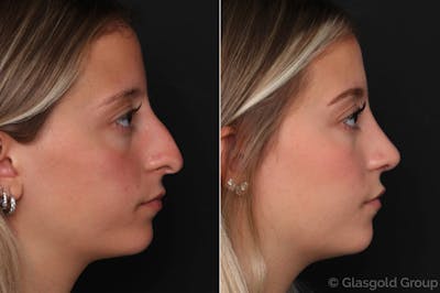 Rhinoplasty Before & After Gallery - Patient 331438 - Image 1