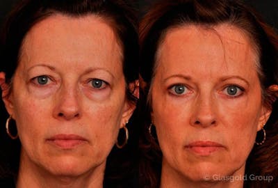 Upper Eyelid Before & After Gallery - Patient 259865 - Image 1