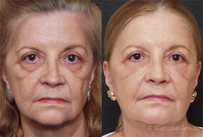 Lower Eyelid Before & After Gallery - Patient 395434 - Image 1