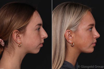 Chin Implants Before & After Gallery - Patient 156264 - Image 1