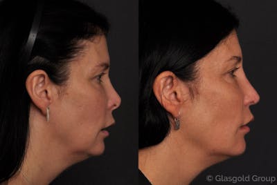 Revision Rhinoplasty Before & After Gallery - Patient 420398 - Image 1