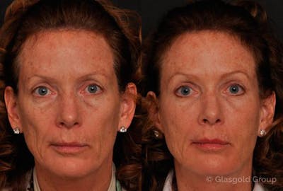 Upper Eyelid Before & After Gallery - Patient 283242 - Image 1