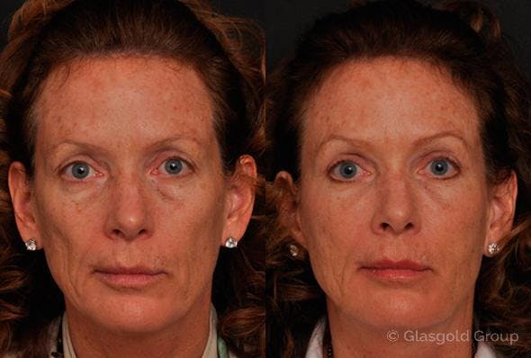 Upper Eyelid Before & After Gallery - Patient 283242 - Image 1