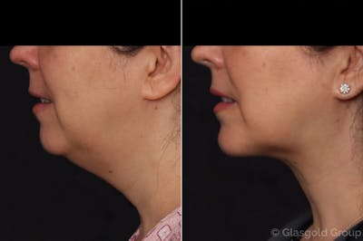 Chin Implants Before & After Gallery - Patient 313646 - Image 1