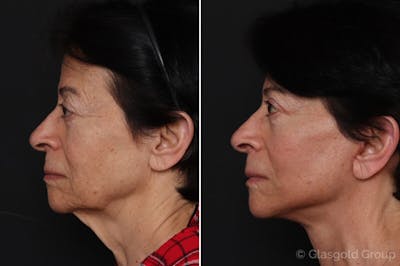 Facelift Before & After Gallery - Patient 223753 - Image 1