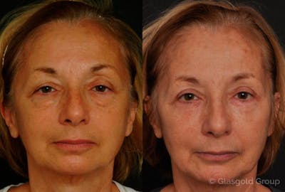 Upper Eyelid Before & After Gallery - Patient 550915 - Image 1