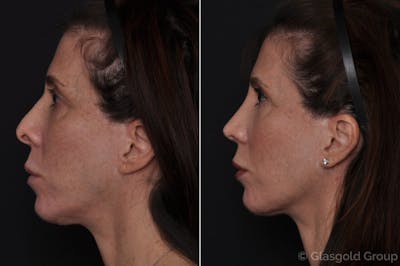 Revision Rhinoplasty Before & After Gallery - Patient 360147 - Image 1