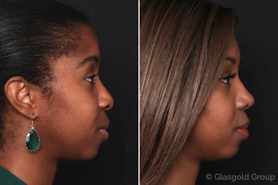 Rhinoplasty Before & After Gallery - Patient 157101 - Image 1