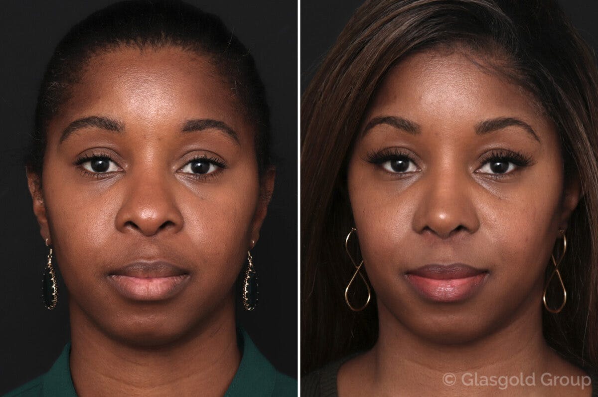 Rhinoplasty Before & After Gallery - Patient 157101 - Image 2