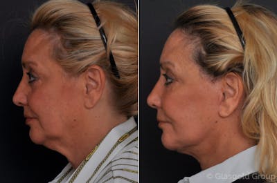 Facelift Before & After Gallery - Patient 168329 - Image 1