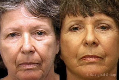 Upper Eyelid Before & After Gallery - Patient 749926 - Image 1
