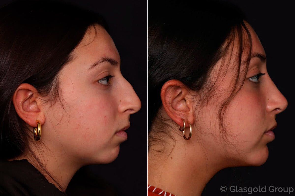 Chin Implants Before & After Gallery - Patient 214724 - Image 1