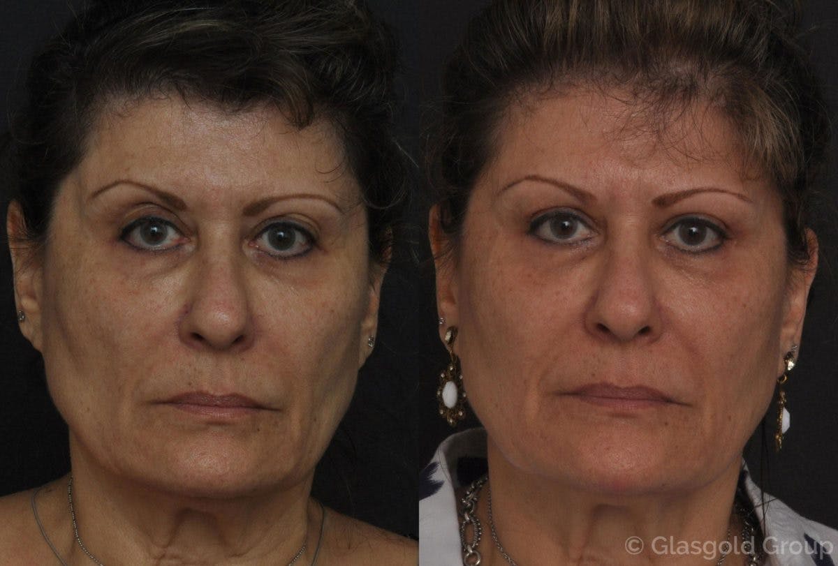 Upper Eyelid Before & After Gallery - Patient 194163 - Image 2