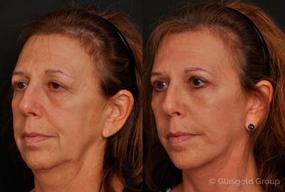 Lower Eyelid Before & After Gallery - Patient 407245 - Image 1
